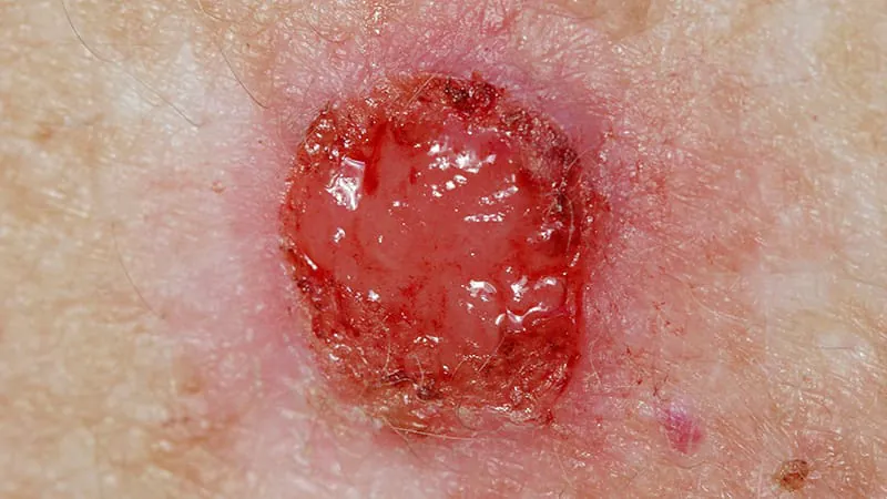 AI-powered skin scanner spots basal cell cancers before they're even visible