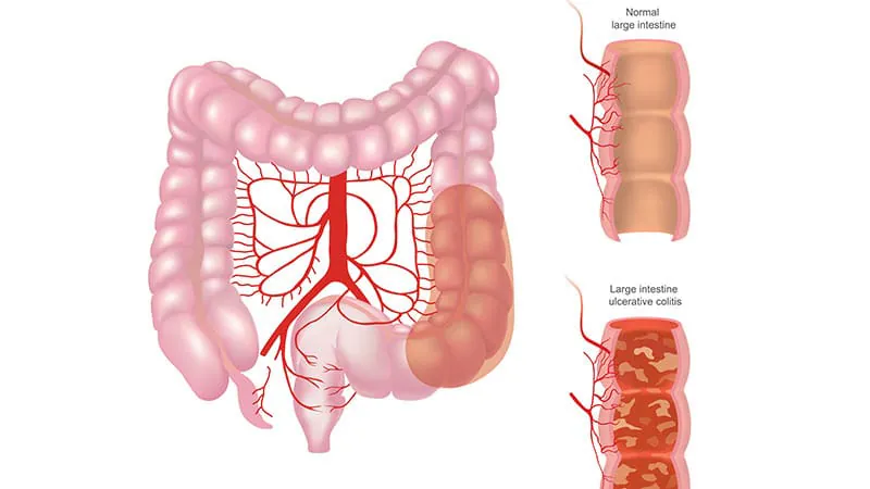 GLP-1 drugs show surprising benefit for ulcerative colitis patients
