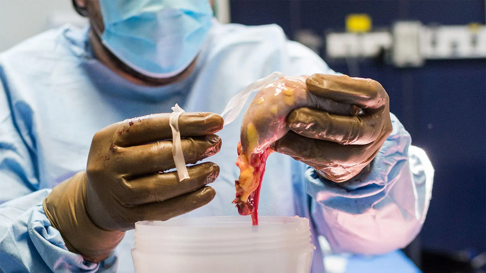 Kidney transplant access is being held back by broken incentives and policy gaps