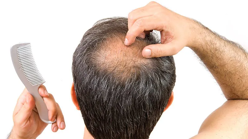 GLP-1 receptor gene expression linked to higher risk of male pattern baldness