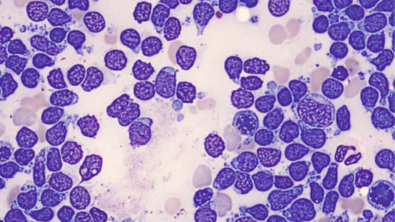 Pediatric leukemia treatment shows durable 10-year survival in young adults — but completion rates remain a challenge