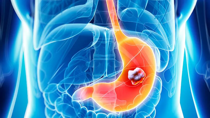 Mismatch repair deficiency signals better survival in oesophagogastric cancer patients on chemo