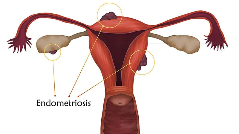 Not all endometriosis is the same — and the risk factors prove it