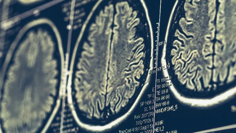 A simple brain scan could predict dementia progression in early-onset Alzheimer's