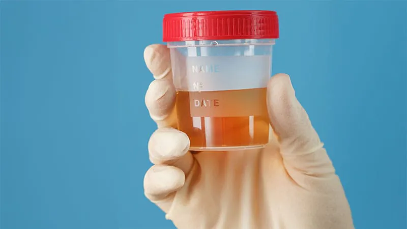 Urine cultures could fast-track urosepsis diagnosis and treatment