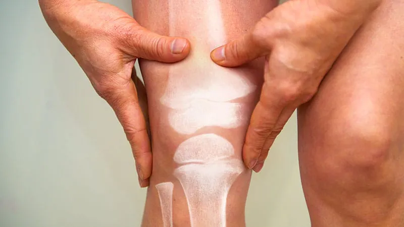 Colchicine falls flat for knee osteoarthritis pain in new trial