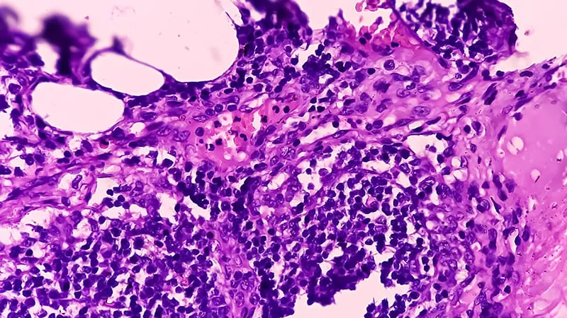 A molecular clue hiding in thyroid cancer: RET fusion predicts hidden lymph node spread