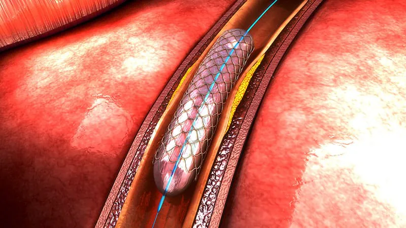 Smarter stenting: functional angiography outperforms conventional angiography in heart attack patients