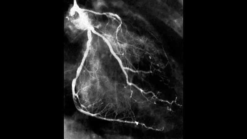 Prasugrel vs. ticagrelor for ACS: A 20-year debate still unsettled