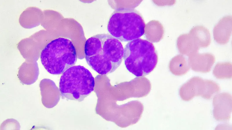 Azacitidine-venetoclax outperforms standard chemo in fit AML patients