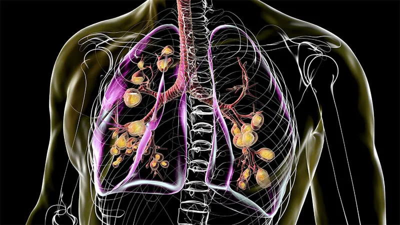 New science and global teamwork are changing the game for kids with rare lung diseases