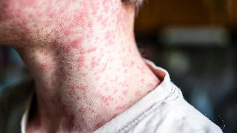 Vaccine-preventable diseases are making a comeback — here's why