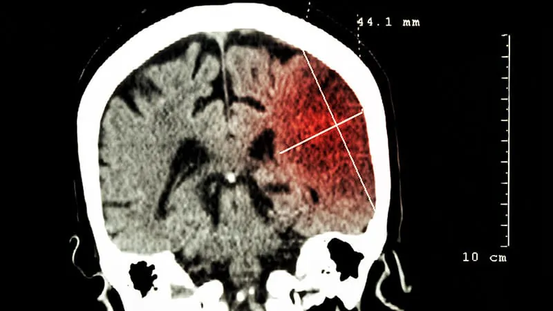 Cancer diagnosis opens a critical window for stroke risk — especially for lung and pancreatic patients