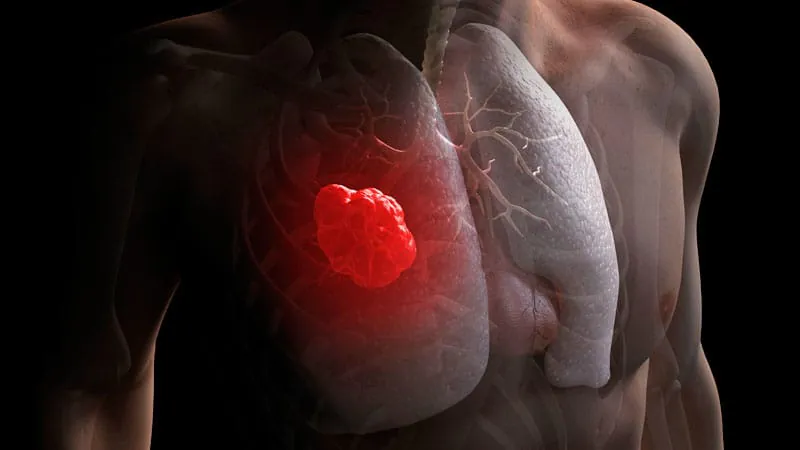 FDA greenlights sevabertinib as first-line treatment for HER2-mutated lung cancer