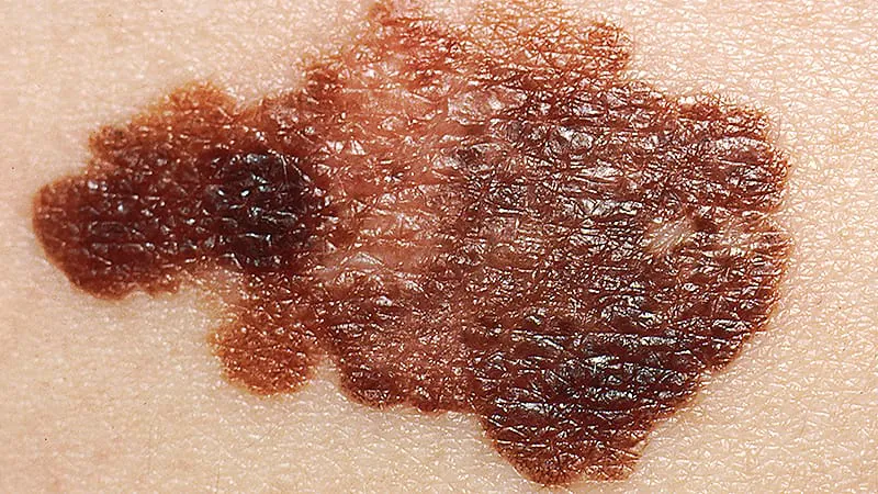 Immunotherapy after melanoma surgery boosts survival — but only in matched patients, not the broader population