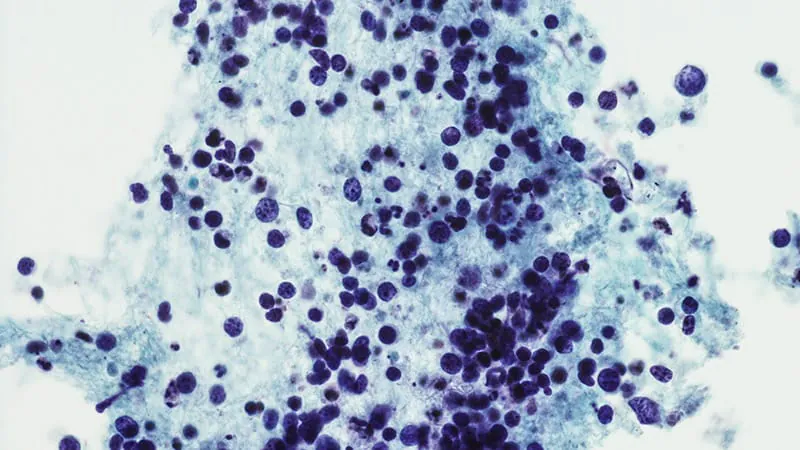 Skipping brain radiation in small-cell lung cancer may actually be better for patients