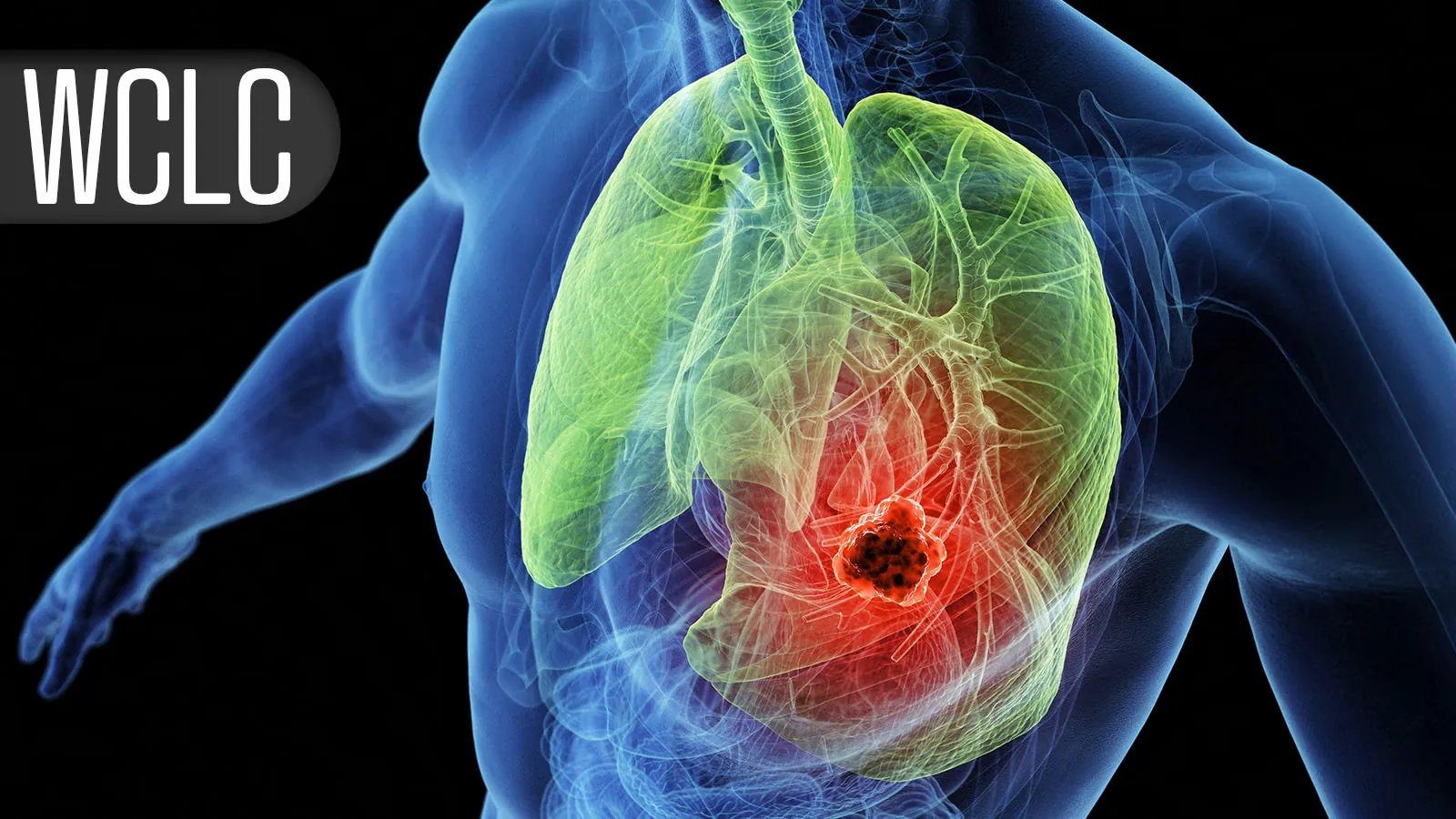 Two new ADCs slash death risk by 54% in relapsed small-cell lung cancer