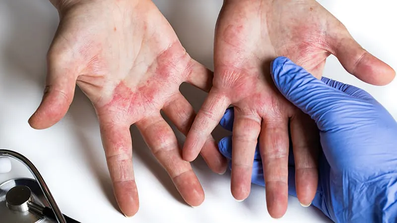 AAD's first guidelines on treatment-resistant eczema urge clinicians to look beyond the obvious