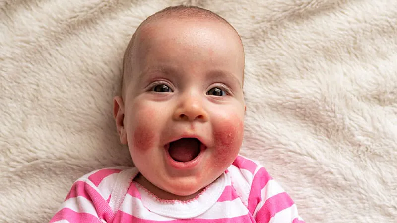 Biologics are transforming pediatric atopic dermatitis — and the pipeline keeps growing