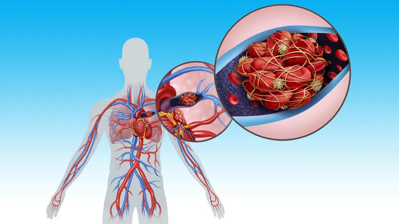 Catheter-directed thrombolysis slashes risk in intermediate-high-risk pulmonary embolism