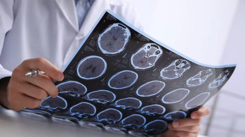 B-cell therapies cut MS relapses by 62% — but disability outcomes tell a different story