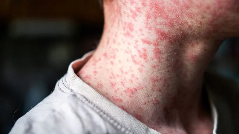 Measles isn't just a kids' disease anymore — adults are being hit hard
