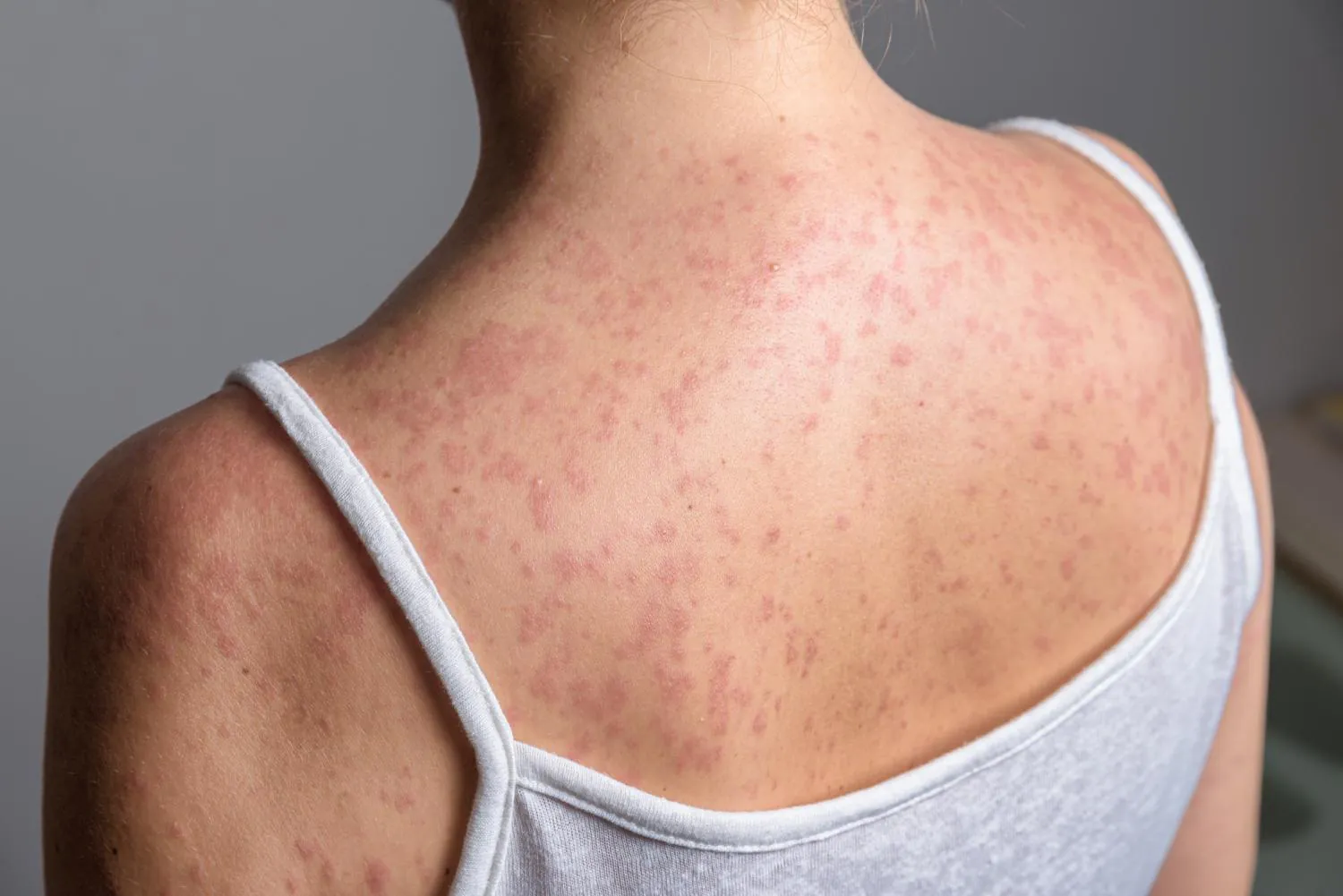 CDC's measles death counting shift leaves experts — and the public — in the dark