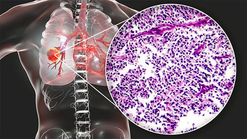 Two new cancer drugs slash death risk by 54% in hard-to-treat lung cancer