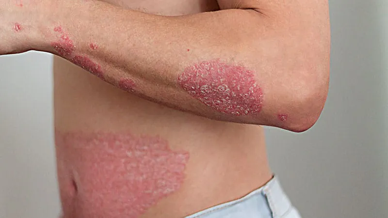 A new oral psoriasis pill just got the FDA's fast-track stamp of approval