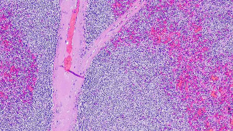 CAR T therapy liso-cel delivers real-world results matching clinical trials in mantle cell lymphoma