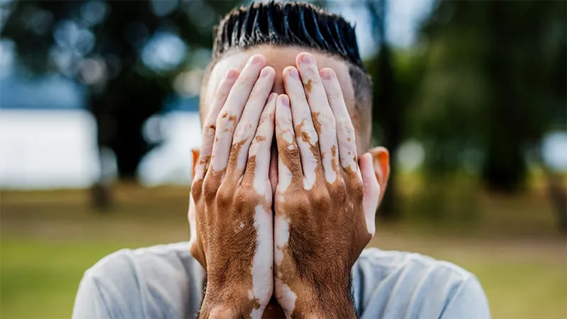Vitiligo patients fear losing hard-won skin gains even after successful treatment