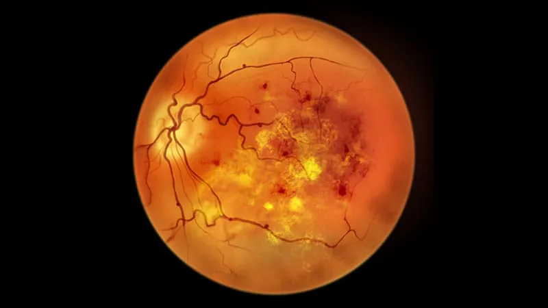 Everyday anti-inflammatory drugs may protect diabetic eyes