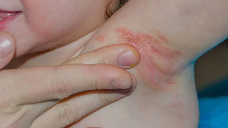 Smoke exposure — even secondhand — raises hidradenitis suppurativa risk in kids