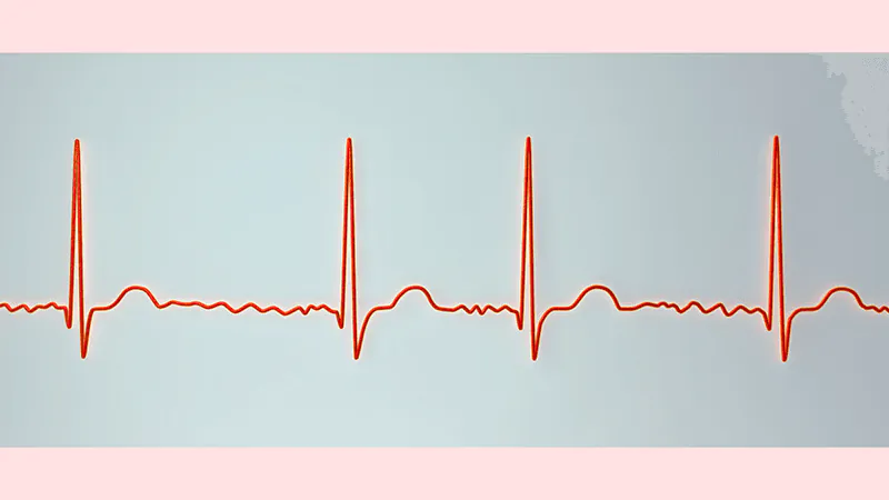 Tirzepatide and heart rhythm: No atrial fibrillation link, but arrhythmia signal worth watching