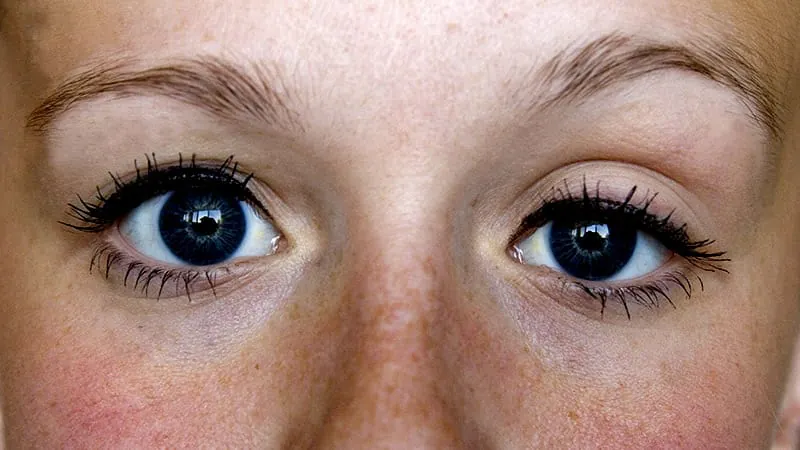 Droopy eyelids and ADHD: A surprising link in kids