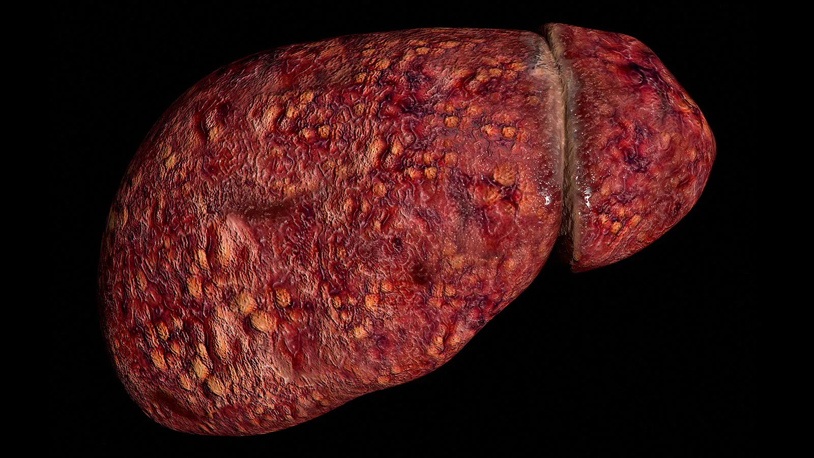 Young adults with fatty liver disease face cirrhosis risk from genes and diabetes combo