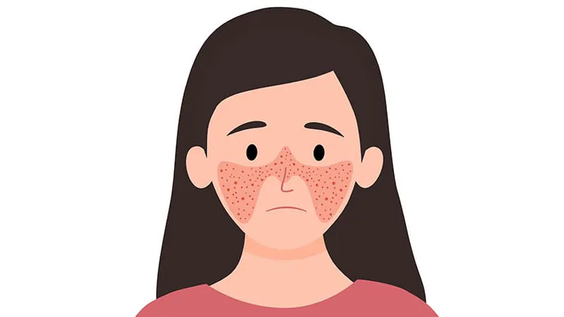 Spotting who's at risk: Key warning signs that drug-induced lupus may turn systemic
