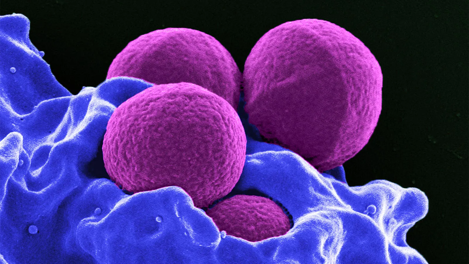 Short-course antibiotics may be just as effective as long-course for orthopedic infections