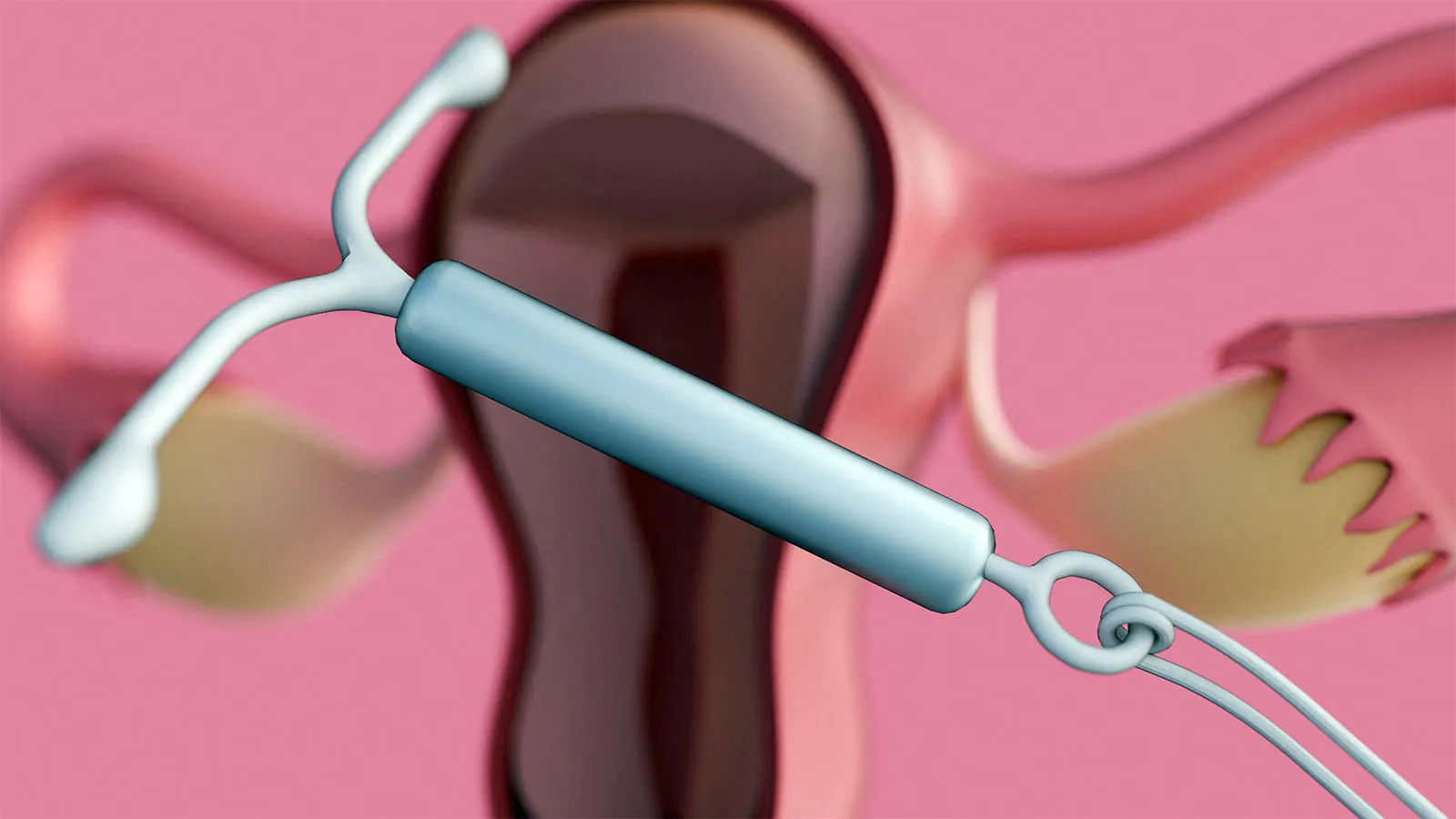 A simple anesthetic could make IUD insertion a lot less painful