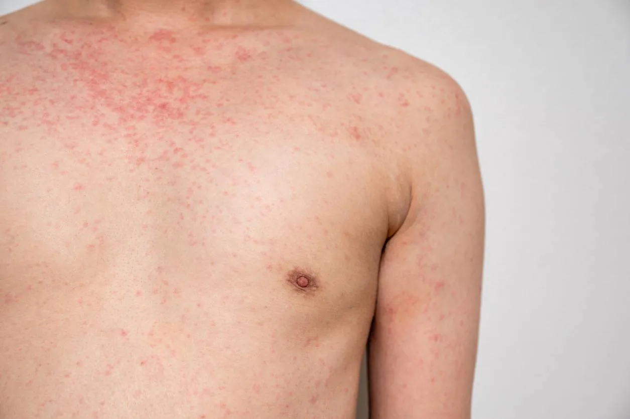 Measles isn't just a kids' disease — adults are getting hit hard in 2026