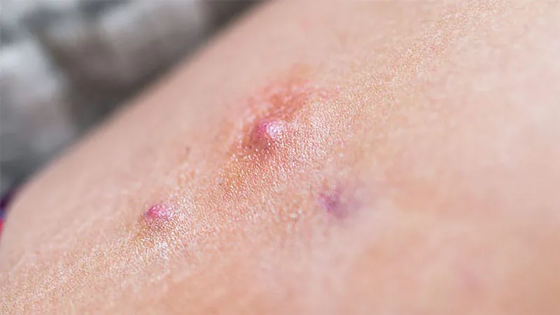 EMA greenlights first oral therapy for hidradenitis suppurativa and a steroid-sparing option for polymyalgia rheumatica