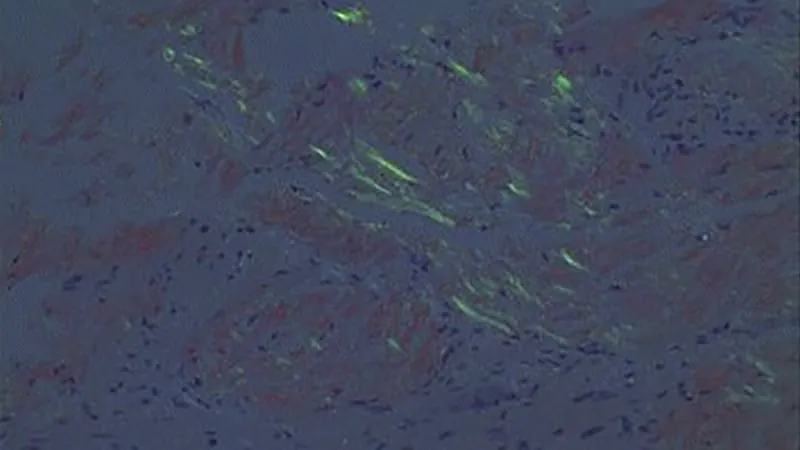 Anselamimab misses the mark in light-chain amyloidosis — but shines in one subgroup