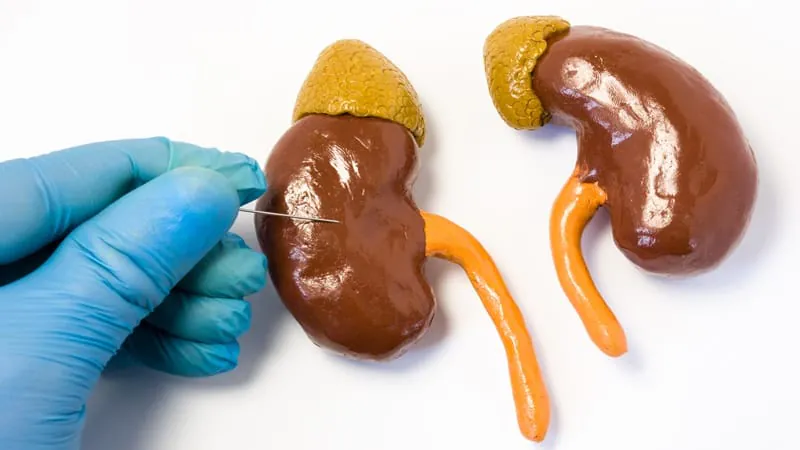 Don't wait for the biopsy: Experts say treat lupus nephritis first, confirm later