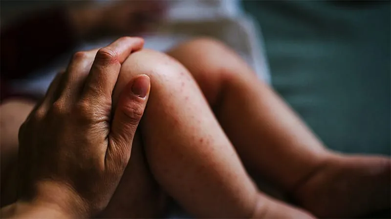 Where eczema shows up on babies may predict food allergy risk