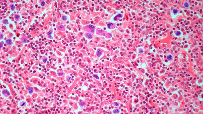 PET-guided nivolumab strategy delivers complete responses in advanced Hodgkin lymphoma