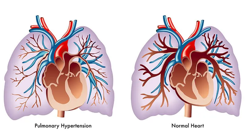 Europe's updated PAH guidelines put sotatercept front and center