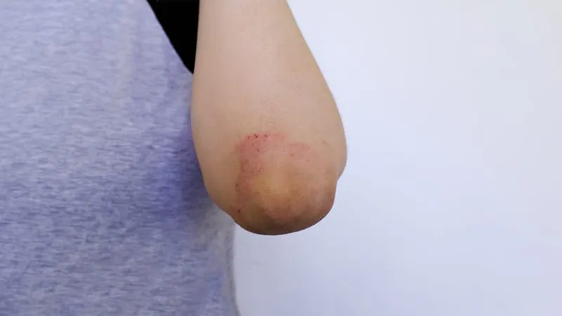 Clear skin, but still itching: Rethinking how we measure atopic dermatitis control