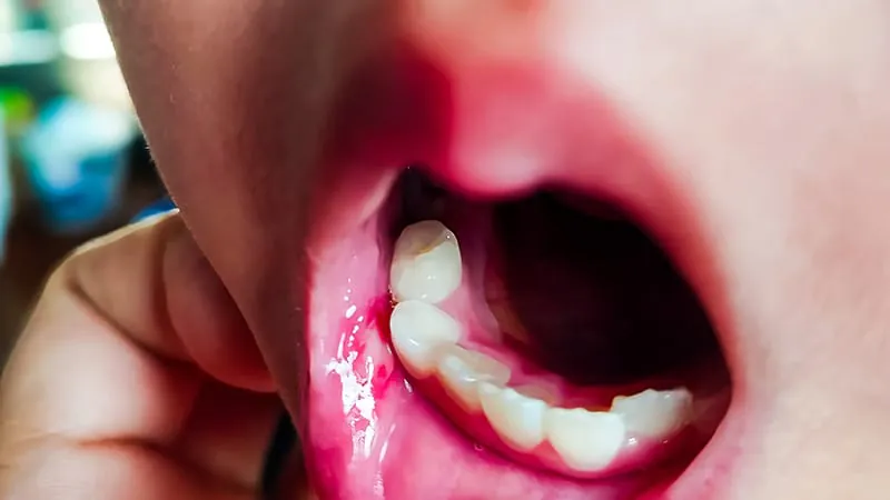Mouth ulcers + genital sores in kids? It could signal something bigger