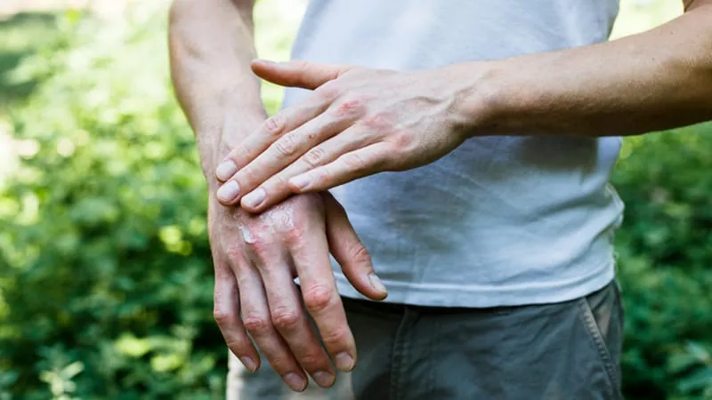 Not all psoriasis treatment failures are created equal — here's how to tell them apart