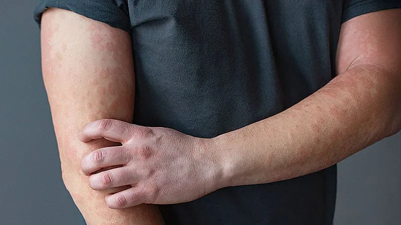 Phototherapy and vitamin D don't move the needle for atopic dermatitis